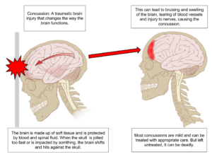 Concussions and traumatic brain injury
